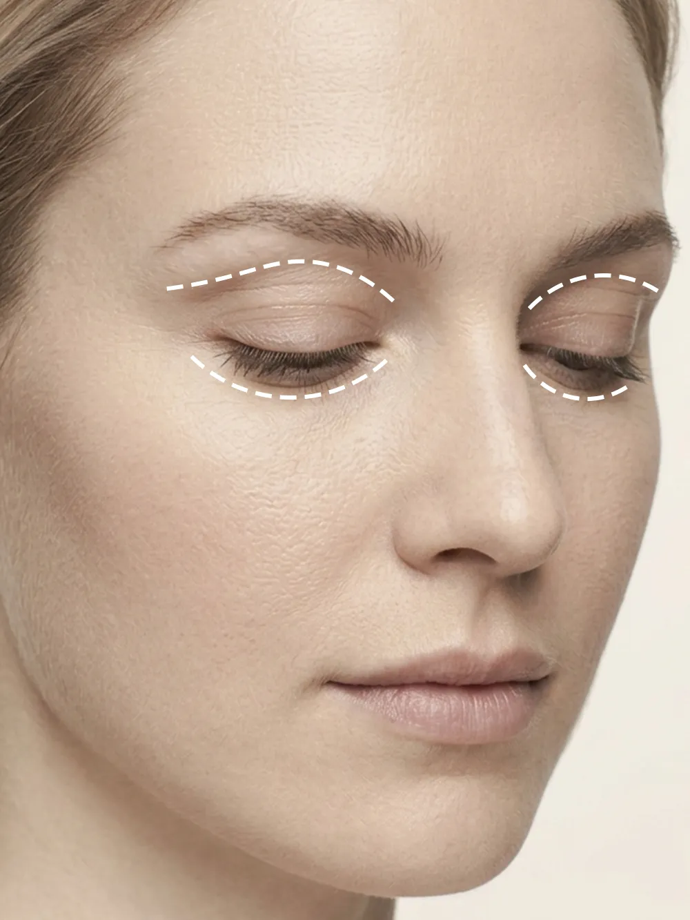 Blepharoplasty (Eyelid Surgery)