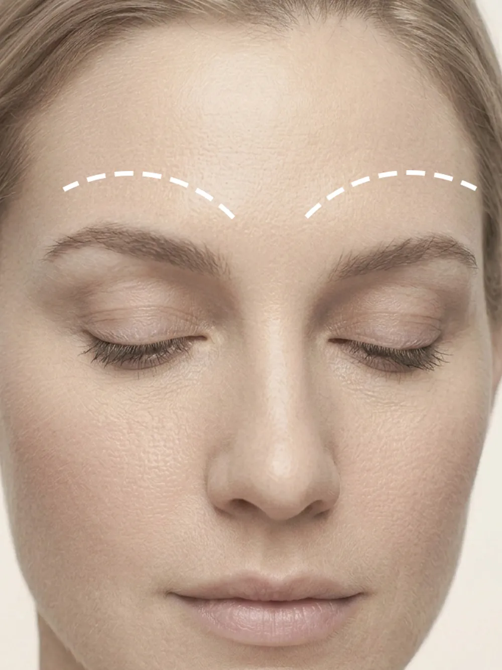 Brow Lift