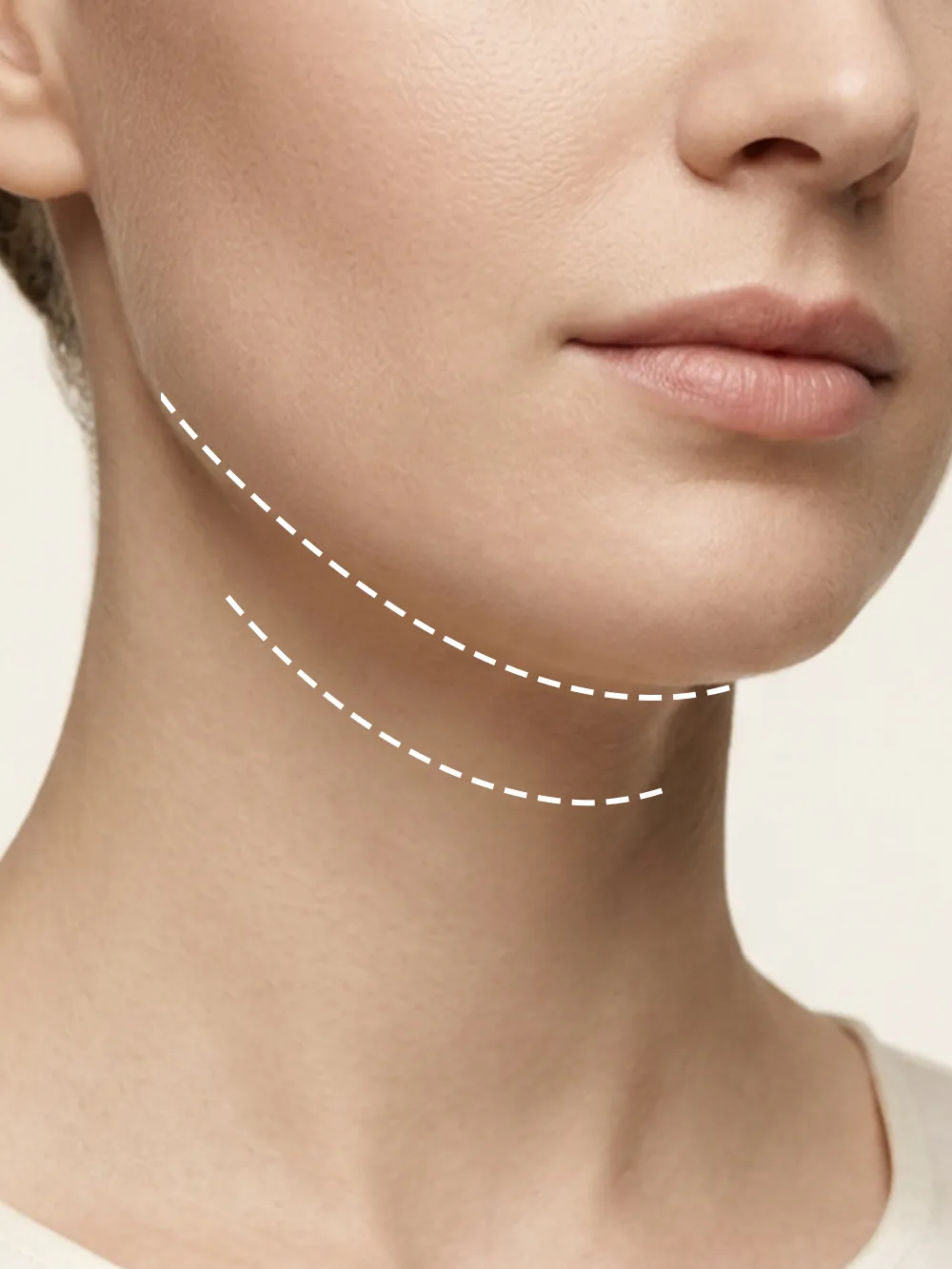 Double Chin Liposuction