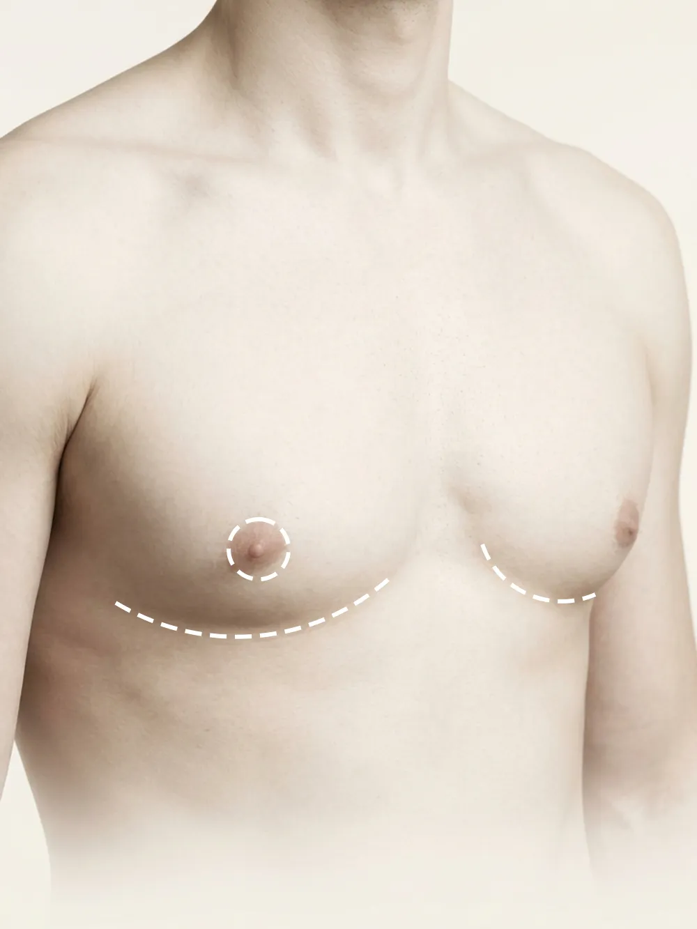 Male Breast Reduction (Gynecomastia)